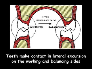 Teeth make contact in lateral excursion
on the working and balancing sides
 