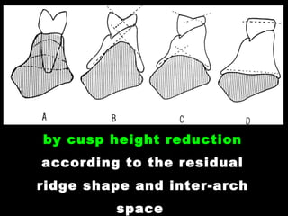 4- Control of horizontal force
by cusp height reduction
according to the residual
ridge shape and inter-arch
space
 