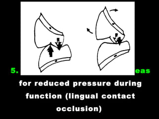 5. Minimum occlusal stop areas
for reduced pressure during
function (lingual contact
occlusion)
 