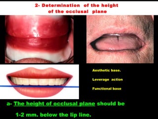 a- The height of occlusal plane should be
1-2 mm. below the lip line.
Aesthetic base.
Leverage action
Functional base
2- Determination of the height
of the occlusal plane
 