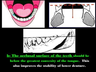 b- The occlusal surface of the teeth should be
below the greatest convexity of the tongue. This
also improves the stability of lower denture.
 