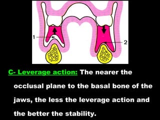 C- Leverage action: The nearer the
occlusal plane to the basal bone of the
jaws, the less the leverage action and
the better the stability.
 