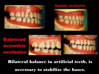 Bilateral balance in artificial teeth, is
necessary to stabilize the bases.
Centric occlusion
Balanced
eccentric
occlusion
 