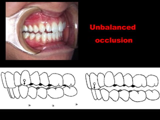 Unbalanced
occlusion
 