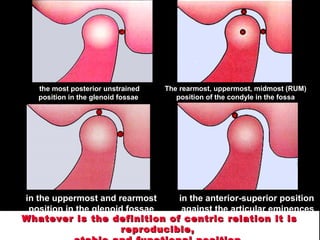 Whatever is the definition of centric relation it isWhatever is the definition of centric relation it is
reproducible,reproducible,
The rearmost, uppermost, midmost (RUM)
position of the condyle in the fossa
the most posterior unstrained
position in the glenoid fossae
in the uppermost and rearmost
position in the glenoid fossae
in the anterior-superior position
against the articular eminences
 