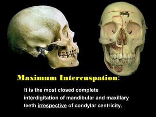 Maximum Intercuspation:
It is the most closed complete
interdigitation of mandibular and maxillary
teeth irrespective of condylar centricity.
 