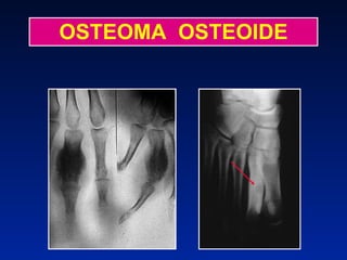 OSTEOMA  OSTEOIDE 