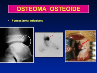 OSTEOMA  OSTEOIDE Formas juxta-articulares 