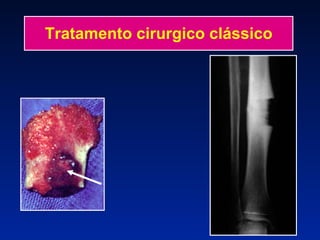 Tratamento cirurgico clássico 