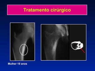 Tratamento cirúrgico Mulher 19 anos  