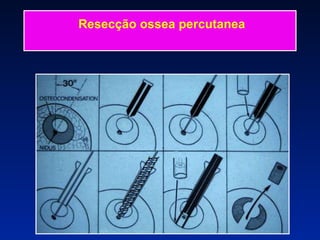 Resecção ossea percutanea 