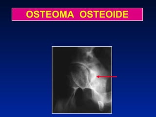 OSTEOMA  OSTEOIDE 