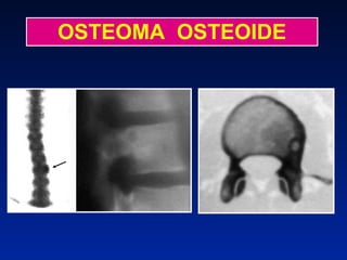 OSTEOMA  OSTEOIDE 