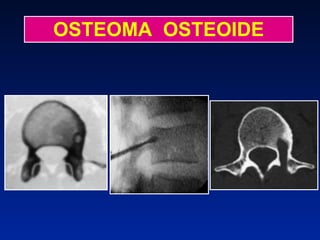 OSTEOMA  OSTEOIDE 