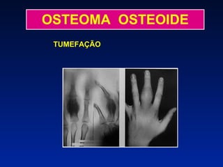 OSTEOMA  OSTEOIDE TUMEFAÇÃO 
