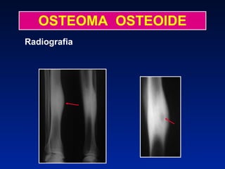 OSTEOMA  OSTEOIDE Radiografia 