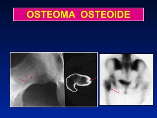 OSTEOMA  OSTEOIDE 