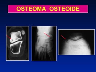 OSTEOMA  OSTEOIDE 