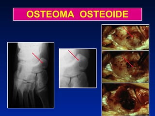 OSTEOMA  OSTEOIDE 