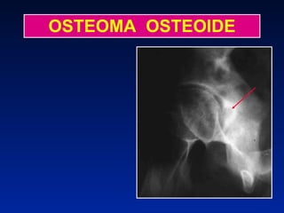 OSTEOMA  OSTEOIDE 