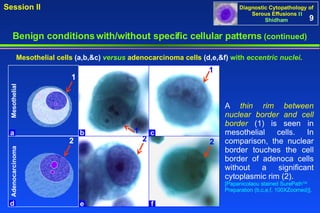 Benign conditions with/without specific cellular patterns  (continued) A  thin rim between nuclear border and cell border  (1) is seen in mesothelial cells. In comparison, the nuclear border touches the cell border of adenoca cells without a significant cytoplasmic rim (2).  [Papanicolaou stained SurePath TM  Preparation (b,c,e,f, 100XZoomed)]. Mesothelial cells  (a,b,&c)   versus  adenocarcinoma cells  (d,e,&f)   with   eccentric nuclei .   9 2 2 2 f e d Adenocarcinoma 1 1 1 a c b Mesothelial 