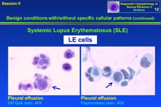 Benign conditions with/without specific cellular patterns  (continued) Session II Systemic Lupus Erythematosus (SLE) LE cells 12 Pleural effusion ,   Diff Quik stain, 40X Pleural effusion ,   Papanicolaou stain, 40X 