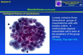 Mesothelioma  (continued) Cytological features of mesothelioma Loosely cohesive three-dimensional  groups of mesothelioma cells with knobby outline.  A multinucleate atypical mesothelial cell is seen at the periphery of the group (arrow).  Thinprep. Pap stain 40x. 22 