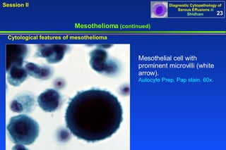 Mesothelioma  (continued) Cytological features of mesothelioma Mesothelial cell with prominent microvilli (white arrow).  Autocyte Prep. Pap stain. 60x. 23 