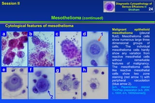 Mesothelioma  (continued) Cytological features of mesothelioma Malignant epithelioid mesothelioma  (pleural fluid). Mesothelioma cells show numerous large three dimensional groups of cells. The individual mesothelioma cells hardly show any variation from reactive mesothelial cells without remarkable features of malignancy. The mesothelioma cells like reactive mesothelial cells show two zone staining (red arrow 1) with peripheral vacuolation (blue arrow 2).  [a-h, Papanicolaou stained ThinPrep preparation (a,b, 20X; c, 100X; d-h, 100XZoomed)]. 24 1 2 a b c e f g h d 