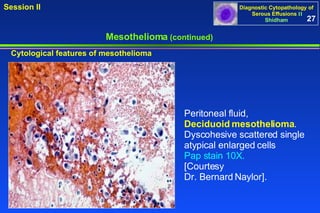Mesothelioma  (continued) Peritoneal fluid, Deciduoid mesothelioma . Dyscohesive scattered single atypical enlarged cells  Pap stain 10X.  [Courtesy  Dr. Bernard Naylor]. Cytological features of mesothelioma 27 