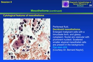 Mesothelioma  (continued) Peritoneal fluid,  Deciduoid mesothelioma.   Enlarged malignant cells with a binucleate form, and glassy cytoplasm. Nuclei are vesicular with prominent nucleoli. Scattered smaller atypical mesothelial cells are present in the background.  Pap stain 40X   [Courtesy Dr. Bernard Naylor]. Cytological features of mesothelioma 28 