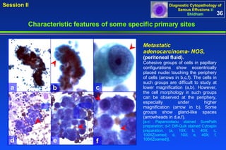 Metastatic adenocarcinoma- NOS ,  (peritoneal fluid).  Cohesive groups of cells in papillary configurations show eccentrically placed nuclei touching the periphery of cells (arrows in b,c,f). The cells in such groups are difficult to study at lower magnification (a,b). However, the cell morphology in such groups can be observed at the periphery, especially under higher magnification (arrow in b). Some groups show gland-like spaces (arrowheads in d,e,f). [a-c: Papanicolaou stained SurePath preparation; d-f: Diff-Quik stained Cytospin preparation. (a, 10X; b, 40X; c, 100XZoomed; d, 10X; e, 40X; f, 100XZoomed)]. 36 Characteristic features of some specific primary sites   a b c d e f 