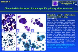a b c d e f w 2 1 Metastatic poorly differentiated adenocarcinoma of lung,   (pleural fluid). The Diff-Quik stained preparation demonstrates reactive mesothelial cells (arrowhead 1 in a) mixed with a ‘second population’ of cohesive groups of cells (arrow 2 in a) with eccentric nuclei that touch the periphery of the carcinoma cells (arrowheads in b,c,f). Some cells are less cohesive with nearby small groups or solitary carcinoma cells (arrows in d,e,f). Occasional intercellular spaces, resembling mesothelial window, are present (arrowhead w in c). The patient had poorly differentiated adenocarcinoma of lung.  [a-c: Diff-Quik stained Cytospin preparation, d-f: Papanicolaou stained SurePath preparation. (a, 10X; b,c, 100X; d, 10X; e,f, 100X)].  37 Characteristic features of some specific primary sites   (continued) 