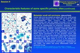 a c d g h e f i j RM b RM c g j i h d f e Ly NC RM nm nm NC Metastatic small cell carcinoma,   (pleural fluid). Cancer cells (a,b) are present as solitary cells (c,d), small groups (g,h,i), and large groups (b & j). The cells are small with high nucleocytoplasmic ratios (c,d,g,h.i). The nuclei are hyperchromatic with salt and pepper chromatin (c,d,i). Solitary cancer cells (NC) (c,d) resemble lymphocytes (blue arrow Ly in f) and may be misinterpreted as lymphoma, especially in PAP stained preparations. However, the presence of cohesive groups (g,h,i,j) with various patterns, including Indian-file pattern (g), typify carcinoma. The nuclear molding (arrows nm in g & i) distinguishes them from other poorly differentiated carcinomas. Mitotic figures (arrowhead in e) and apoptotic cancer cells (arrowheads in d,f,h) are also present. Rare reactive mesothelial cells (blue arrows RM in a,b,e) are present with a few chronic inflammatory cells (blue arrow Ly in f) in the background. Immunostained cell block sections showed immunoreactivity for neuroendocrine immunomarkers (chromogranin, synaptophysin, and CD56). The patient had poorly differentiated small cell carcinoma of lung.  (NC, neoplastic cell; RM, reactive mesothelial cell, nm, nuclear molding, Ly, lymphocyte) [a-j: Papanicolaou stained SurePath preparation. (a-b, 100X; c-j, 100XZoomed)]. 38 Characteristic features of some specific primary sites   (continued) 