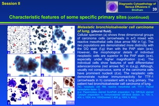 a b c d e f g h RM NC NC NC RM TTF-1 Metastatic bronchioloalveolar cell carcinoma of lung ,  (pleural fluid). Cellular specimen (a) shows three dimensional groups of carcinoma cells (arrowheads in a-f) mixed with reactive mesothelial cells (blue arrow RM in f,g). The  two populations  are demonstrated more distinctly with the DQ stain (f,g) than with the PAP stain (a-e). However, the  morphological details  of individual neoplastic cells are superior in the PAP stain (a-e), especially under higher magnification (c-e). The individual cells show features of well differentiated adenocarcinoma (red arrows NC in d,e,g). Although, usually not conspicuous, some of the carcinoma cells have prominent nucleoli (d,e). The neoplastic cells demonstrate nuclear immunoreactivity for TTF-1 (arrowheads in h) consistent with a lung primary. The patient had bronchioloalveolar cell carcinoma of lung.  (NC, neoplastic cell; RM, reactive mesothelial cell; TTF-1 Thyroid transcription factor- 1) [a-e: Papanicolaou stained SurePath preparation; f-g: Diff-Quik stained Cytospin preparation; h: Immunostained cell-block section. (a, 10X; b, 40X; c, 100X; d-e, 100XZoomed; f, 40X; g, 100X; h, 40X)].  39 Characteristic features of some specific primary sites   (continued) 