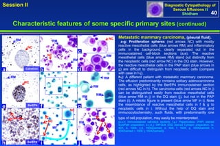 Metastatic mammary carcinoma,  (pleural fluid). a-g:   Proliferation spheres  (red arrows NC) with mostly reactive mesothelial cells (blue arrows RM) and inflammatory cells in the background, clearly separated out in the immunostained cell-block sections (a,e). The reactive mesothelial cells (blue arrows RM) stand out distinctly from the neoplastic cells (red arrow NC) in the DQ stain. However, the reactive mesothelial cells in the PAP stain (blue arrows in g) are difficult to distinguish from neoplastic cells (compare with case in h-j).  h-j:  A different patient with metastatic mammary carcinoma. The effusion predominantly contains solitary adenocarcinoma cells, as highlighted by the BerEP4 immunostained section (red arrows NC in h). The carcinoma cells (red arrows NC in j) can be distinguished easily from reactive mesothelial cells (blue arrow RM in j) in the DQ stain (j), but not in the PAP stain (i). A mitotic figure is present (blue arrow MF in i). Note the resemblance of reactive mesothelial cells in f & g to neoplastic cells in i. Without the help of DQ stain and immunocytochemistry, such fluids, with predominantly one type of cell population, may easily be misinterpreted.   [a,e,h: Immunostained cell-block sections; f,g,i: Papanicolaou (PAP) stained SurePath preparation; b,c,d,,j: Diff-Quik (DQ) stained Cytospin preparation. (a, 40X; b, 100X; c,d, 100XZoomed; e, 40X; f, 100X; g, 100XZoomed; h, 40XZoomed; i, 100X; j, 100XZoomed)]. 40 Characteristic features of some specific primary sites   (continued) Calretinin RM NC BerEP4 RM NC NC BerEP4 NC NC NC RM g i h f e c a j b d MF RM NC RM RM RM RM RM NC RM 