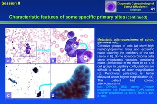Metastatic adenocarcinoma of colon,  (peritoneal fluid). Cohesive groups of cells (a) show high nucleocytoplasmic ratios and eccentric nuclei touching the periphery of the cell (arrow in b). Some adenocarcinoma cells show cytoplasmic vacuoles containing mucin (arrowhead in the inset of b). The cell groups in papillary configurations are difficult to study at lower magnification (c). Peripheral palisading is better observed under higher magnification (d). The patient had colonic adenocarcinoma. [a,b: Diff-Quik (DQ) stained Cytospin preparation, c-d: Papanicolaou (PAP) stained SurePath preparation. (a, 40X; b, 100X; c, 40X; d, 100)].  41 Characteristic features of some specific primary sites   (continued) a b c d 