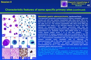Metastatic gastric adenocarcinoma,  (peritoneal fluid).  The specimen contained a predominance of solitary neoplastic cells (red arrows a,d) with rare reactive mesothelial cells (blue arrow RM in a). Most of the cancer cells have eccentric nuclei touching the periphery of the cells (a,b,c,d). The reactive mesothelial cells (blue arrow RM) are identifiable more easily in the Diff-Quik stained (a) than in the PAP stained (c) preparation. The solitary carcinoma cells may be misinterpreted as high-grade lymphoma cells, especially in PAP stained preparations (c,d). Apoptotic cancer cells (yellow arrow ‘e’ in c) and mitotic figures (yellow arrow ‘f’ in c) are also present.  The predominance of solitary neoplastic cells (a-j) is confirmed in the HE stained (g & h) and BerEP4 (i) immunostained cell-block sections. A few CK 7 immunoreactive mesothelial cells, as intrinsic positive control, are present amongst many neoplastic cells (j). Although, the adenocarcinoma cells in this case were non-immunoreactive for CK 7 (j), a significant proportion of gastric adenocarcinomas are immunoreactive for CK 7. The patient had linitis plastica type diffuse anaplastic gastric adenocarcinoma.  (AP, apoptotic cancer cell; CK 7, cytokeratin 7; MF, mitotic figure; NC, neoplastic cell; RM, reactive mesothelial cell) [a-b: Diff-Quik (DQ) stained Cytospin preparation; c-f: Papanicolaou (PAP) stained SurePath preparation; g,h: HE stained cell-block section; i,j: Immunostained cell-block sections. (a, 100X; b, 100XZoomed; c, 100X; d-f, 100XZoomed; g, 40X; h-j 100X)]. 42 Characteristic features of some specific primary sites   (continued) a c b d g h e f i j RM d f e b BerEP4 CK 7 NC NC AP MF 