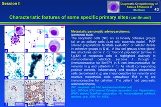 Metastatic pancreatic adenocarcinoma,  (peritoneal fluid).  The neoplastic cells (NC) are as loosely cohesive groups (a) or as solitary cells (b,e) with eccentric nuclei.  PAP stained preparations facilitate evaluation of cellular details in cohesive groups (c & d).  A few cell groups show gland-like structures (arrow in d). ‘Second population’ (arrows in f,g,&h) of neoplastic cells is highlighted distinctly in immunostained cell-block sections f through h (immunoreactive for BerEP4 in f, non-immunoreactive for vimentin in g and calretinin in h). As inbuilt corresponding positive controls, inflammatory and reactive mesothelial cells (arrowhead in g) are immunoreactive for vimentin and reactive mesothelial cells (arrowhead RM in h) are immunoreactive for calretinin. The patient had pancreatic adenocarcinoma.  (NC, neoplastic cell; RM, reactive mesothelial cell) [a-b: Diff-Quik (DQ) stained Cytospin preparation; c-e: Papanicolaou (PAP) stained SurePath preparation; f-h: Immunostained cell-block sections. (a-e, 100X; f-h, 40X)].  43 Characteristic features of some specific primary sites   (continued) BerEP4 f d e c b a bi bii vimentin NC NC NC NC Calretinin RM g h 