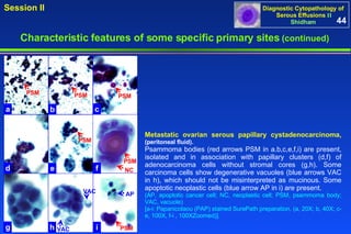 Metastatic ovarian serous papillary cystadenocarcinoma,  (peritoneal fluid).  Psammoma bodies (red arrows PSM in a.b,c,e,f,i) are present, isolated and in association with papillary clusters (d,f) of adenocarcinoma cells without stromal cores (g,h). Some carcinoma cells show degenerative vacuoles (blue arrows VAC in h), which should not be misinterpreted as mucinous. Some apoptotic neoplastic cells (blue arrow AP in i) are present. (AP, apoptotic cancer cell; NC, neoplastic cell; PSM, psammoma body; VAC, vacuole) [a-i: Papanicolaou (PAP) stained SurePath preparation. (a, 20X; b, 40X; c-e, 100X, f-i , 100XZoomed)]. 44 Characteristic features of some specific primary sites   (continued) a b c d e f g h i PSM VAC PSM PSM PSM PSM AP PSM VAC NC 