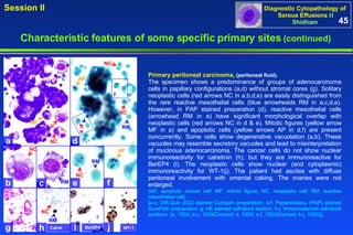 Primary peritoneal carcinoma,  (peritoneal fluid). The specimen shows a predominance of groups of adenocarcinoma cells in papillary configurations (a,d) without stromal cores (g). Solitary neoplastic cells (red arrows NC in a,b,d,e) are easily distinguished from the rare reactive mesothelial cells (blue arrowheads RM in a,c,d,e). However, in PAP stained preparation (d), reactive mesothelial cells (arrowhead RM in e) have significant morphological overlap with neoplastic cells (red arrows NC in d & e). Mitotic figures (yellow arrow MF in a) and apoptotic cells (yellow arrows AP in d,f) are present concurrently. Some cells show degenerative vacuolation (a,b). These vacuoles may resemble secretory vacuoles and lead to misinterpretation of mucinous adenocarcinoma. The cancer cells do not show nuclear immunoreactivity for calretinin (h), but they are immunoreactive for BerEP4 (i). The neoplastic cells show nuclear (and cytoplasmic) immunoreactivity for WT-1(j). The patient had ascites with diffuse peritoneal involvement with omental caking. The ovaries were not enlarged.  (AP, apoptotic cancer cell; MF, mitotic figure; NC, neoplastic cell; RM, reactive mesothelial cell) [a-c: Diff-Quik (DQ) stained Cytospin preparation; d-f: Papanicolaou (PAP) stained SurePath preparation; g: HE stained cell-block section; h-j: Immunostained cell-block sections. (a, 100X; b,c, 100XZoomed; d, 100X; e,f, 100XZoomed; h-j, 100X)]. 45 Characteristic features of some specific primary sites   (continued) a d b c g h e f i j WT-1 BerEP4 Calret c b RM NC AP e f RM NC AP MF NC RM NC NC RM NC 