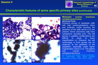 a b c d Metastatic ovarian mucinous cystadenocarcinoma,  (peritoneal fluid). Cohesive groups of neoplastic cells with high nucleocytoplasmic ratios and eccentric nuclei touching the periphery of the cells (arrow in b) are present. Some carcinoma cells have cytoplasmic vacuoles (a,b). The cell groups in papillary configurations are difficult to study at lower magnification (c). However, the cell morphology in such groups can be observed at the periphery of the papillation, especially under higher magnification (arrow in d). The patient had ovarian mucinous cystadenocarcinoma. [a,b: Diff-Quik (DQ) stained Cytospin preparation; c,d: Papanicolaou (PAP) stained SurePath preparation. (a, 40X; b, 100X; c, 40X; d, 100X)]. 46 Characteristic features of some specific primary sites   (continued) 