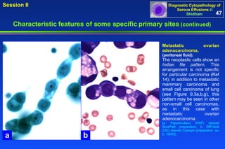 Metastatic ovarian adenocarcinoma,  (peritoneal fluid). The neoplastic cells show an  Indian file pattern.  This arrangement is not specific for particular carcinoma (Ref 14); in addition to metastatic mammary carcinoma and small cell carcinoma of lung (see Figure 9.3a,b,g), this pattern may be seen in other non-small cell carcinomas, as in this case with metastatic ovarian adenocarcinoma.  [a: Papanicolaou (PAP) stained SurePath preparation; b: Diff-Quik (DQ) stained Cytospin preparation. (a-b, 100X)]. 47 Characteristic features of some specific primary sites   (continued) a b 