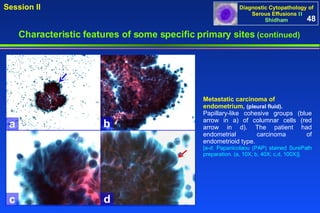 Metastatic carcinoma of endometrium,  (pleural fluid). Papillary-like cohesive groups (blue arrow in a) of columnar cells (red arrow in d). The patient had endometrial carcinoma of endometrioid type. [a-d: Papanicolaou (PAP) stained SurePath preparation. (a, 10X; b, 40X; c,d, 100X)]. 48 Characteristic features of some specific primary sites   (continued) a b c d 