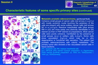 Metastatic prostatic adenocarcinoma,  (peritoneal fluid).   Cohesive small groups of cancer cells (red arrows in a,e,f,i,j) with mostly eccentric nuclei touching the periphery of the cells are present with some solitary cancer cells (red arrows NC in a,,c,d,f,g,h). Reactive mesothelial cells (blue arrows RM in a,b) are more easily and distinctly identifiable in DQ stained (a) than in PAP stained (f) preparations. Most cancer cells were poorly cohesive, manifested by the presence of small groups (e,i,j) or solitary cells (c,d,g,h). Some cells show vacuolation (f,g,h,i,j) which may be  in vitro  degenerative or functional with secretion. The patient had prostatic adenocarcinoma with colonic metastasis. The primary tumor also showed a few vacuolated cancer cells in tissue sections. (NC, neoplastic cell; RM, reactive mesothelial cell) [a-e: Diff-Quik (DQ) stained Cytospin preparation; f-j: Papanicolaou (PAP) stained SurePath preparation. (a, 100X; b-e, 100XZoomed; f, 100X; g-j, 100XZoomed)].  49 Characteristic features of some specific primary sites   (continued) RM RM RM a f b c d e g h i j RM RM NC  NC  NC  NC  NC  NC  