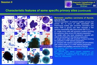 Metastatic papillary carcinoma of thyroid,   (pleural fluid). ‘ Second population’ of cohesive papillary groups (red arrows NC in b,e,f) of cells associated with Psammoma bodies with concentric lamination (red arrow PSM in g2,h2’) are seen amongst a few reactive mesothelial cells (blue arrows RM in b,i).  d1, single tumor cells with eccentric nucleus touching the periphery (blue arrow) DQ stained preparation. d2, single cells may have cytoplasmic vacuole with colloid (arrowhead) in DQ stained preparation. j1, single tumor cells with eccentric nucleus touching the periphery in PAP stained preparation.  j2, compare with reactive mesothelial cell (binucleate) with central nuclei in j1 in PAP stained preparation.  The patient had papillary carcinoma of thyroid.  [NC, neoplastic cell(s); PSM, psammoma body; RM, reactive mesothelial cell(s)] [a-d: Diff-Quik (DQ) stained Cytospin preparation; e-j: Papanicolaou (PAP) stained SurePath preparation. (a, 40X; b,c, 100X; d1,d2, 100XZoomed; e, 10X; f, 40X; g1,g2,h1,h2,i, 100X; j1,j2, 100XZoomed)]. 50 Characteristic features of some specific primary sites   (continued) a b c e g1 f d1 d2 g2 Second focus of ‘h1’  ( bright light) h1 h2 i j1 j2 NC RM NC RM NC NC Second focus of ‘g1’  ( bright light) PSM PSM 