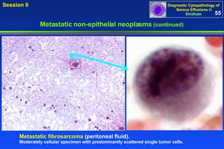 Metastatic non-epithelial neoplasms  (continued) Metastatic fibrosarcoma  (peritoneal fluid).   Moderately cellular specimen with predominantly scattered single tumor cells. 55 