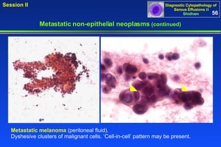 Metastatic non-epithelial neoplasms  (continued) Metastatic melanoma  (peritoneal fluid).  Dyshesive clusters of malignant cells. ‘Cell-in-cell’ pattern may be present.  56 
