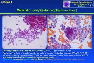 Metastatic non-epithelial neoplasms  (continued) Desmoplastic small round cell tumor   (DSRCT)   (peritoneal fluid).  Dyshesive clusters of small round tumor cells showing rosette-like features (FNAB). DSRCT effusion exhibiting high cellularity. The tumor cells showed nuclear immunoreactivity for WT1. [ With thanks from the article in ‘open access’ cytopathology journal:   Granja NM et al  CytoJournal  2005, 2:6  Free full text at-   http://www.cytojournal.com/content/pdf/1742-6413-2-6.pdf ] 57 