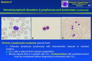Hematolymphoid disorders (Lymphomas and leukemias)  (continued) A.  Follicular lymphoma lymphocyte with characteristic cleaved or notched nucleus. B.  CLL cells in pleural fluid cytospin preparation. C.  Bloody pleural fluid in a patient with CLL.  Contamination  with peripheral blood  must be considered before diagnosing involvement with CLL. Chronic Lymphocytic Leukemia  (pleural fluid)  61 